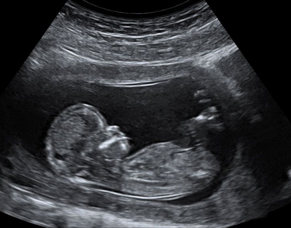 Ultrasound Best Our Services Early Scans
